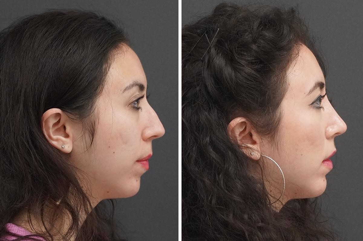 what is a closed rhinoplasty