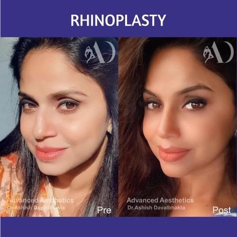 what is a closed rhinoplasty