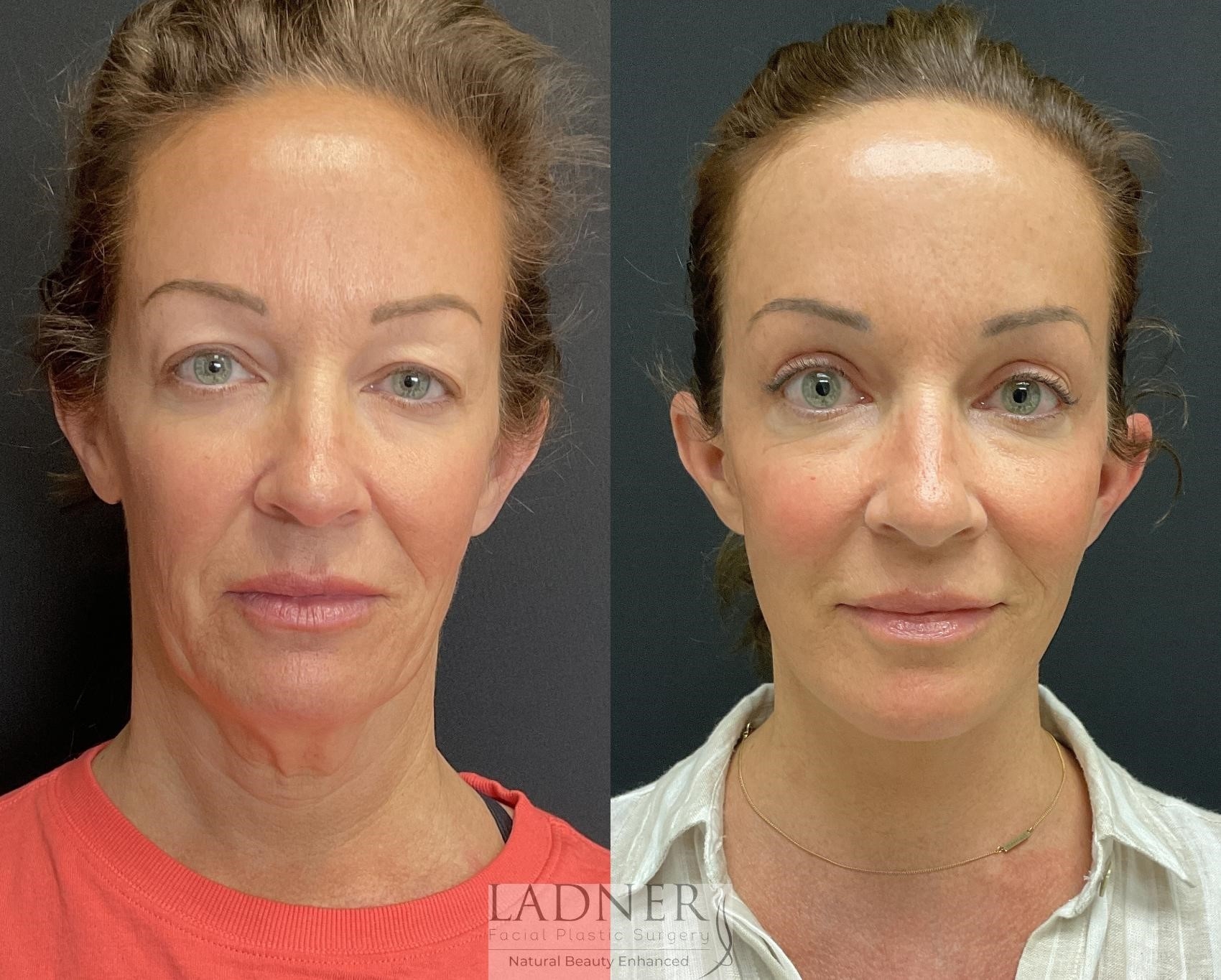 how much is rhinoplasty surgery
