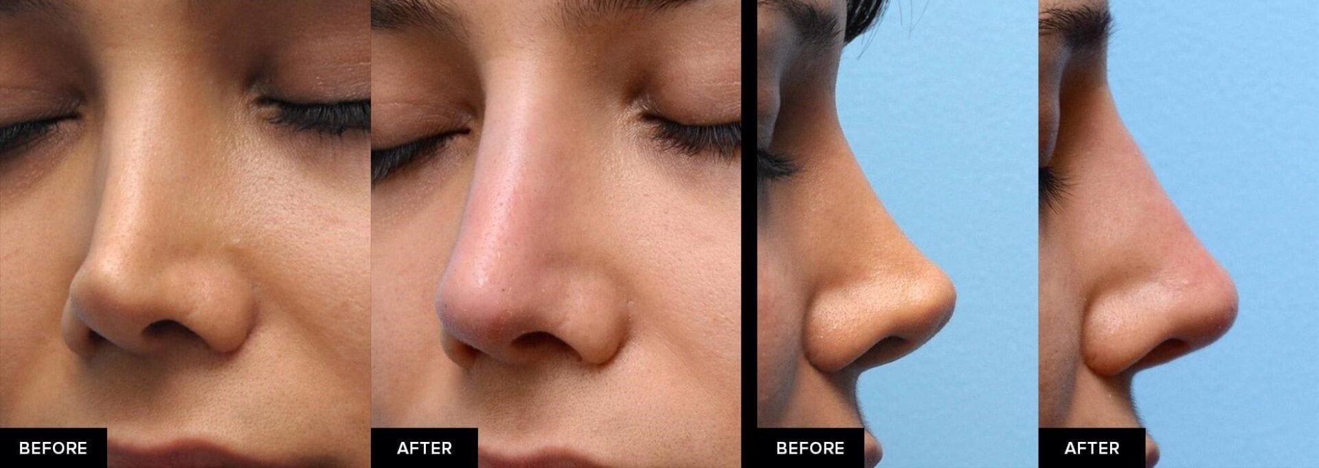 what is a closed rhinoplasty