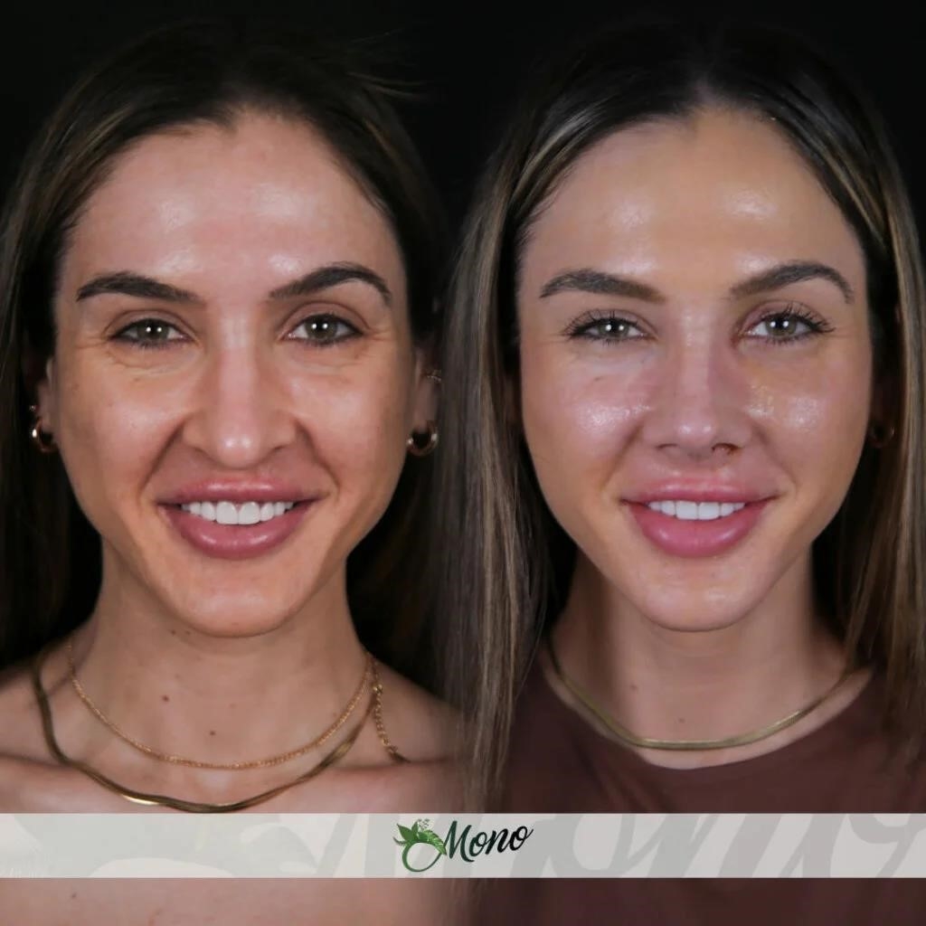 how much is rhinoplasty surgery