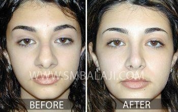 how much is rhinoplasty surgery