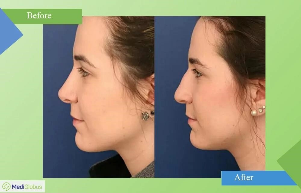 how much is rhinoplasty surgery